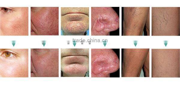 CE approval rbs ultra high frequency rf spider veins