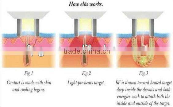 2015 new design ipl/rf hair removal machine (CE Approval)