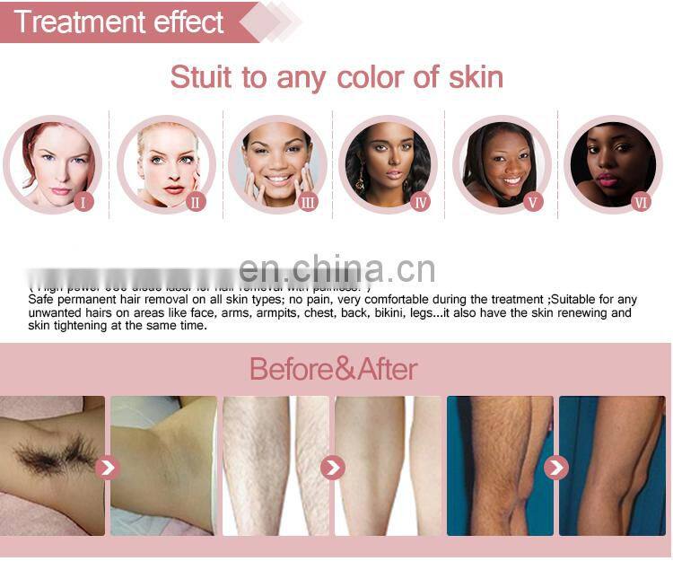 Professional diode laser 755nm 808nm 1064nm hair removal alexandrite laser 755nm by soprano ice platinum