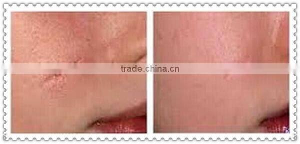 Allfond hot selling portable mesotherapy guns