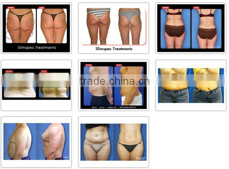 beauty machine high power fat remove machine RF cavitation