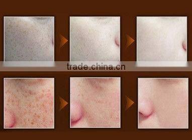 2016 hot selling fda approved ipl laser machine IPL