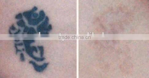 2016 OEM/ODM professional distributors wanted q switch nd yag laser tattoos removal device