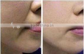 protable E-light hair removal Machine