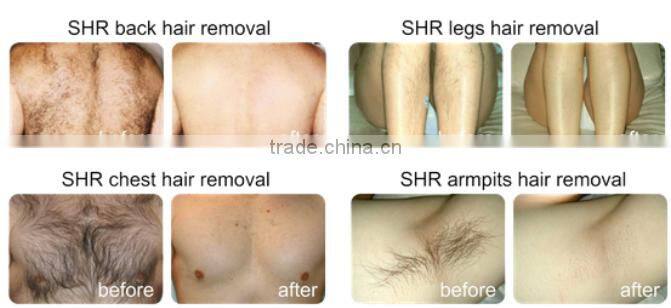 Portable Skin care SHR elight ipl hair removal machine