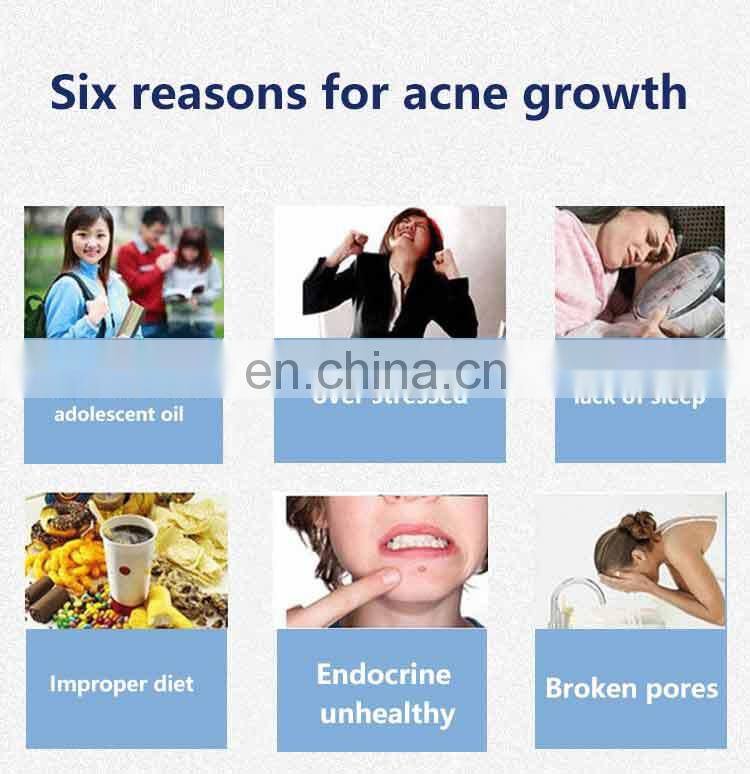 Hot selling best acne treatment acne scar removal blackhead removal beauty device