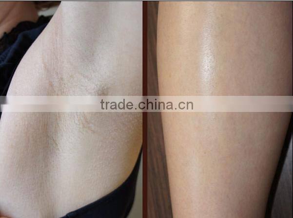 SHR IPL Laser l Skin Care Beauty Equipment for Acne Pigment Wrinkle Removal