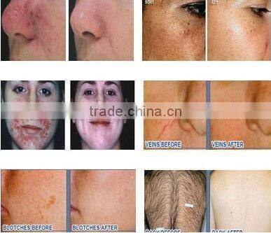 Vertical IPL Hair Removal Salon Equipment