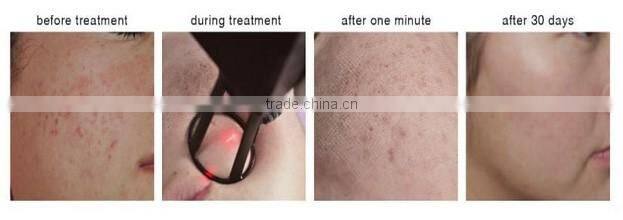 Newest Generation!! Beauty Device Fractional CO2 Laser Equipment Vaginal Tightening Machine with FDA