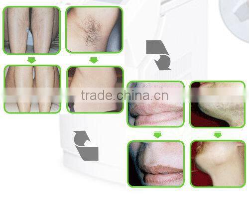 Newest arrival salon laser chest hair removal ipl