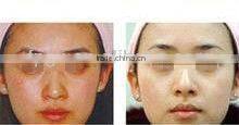 Two handles ipl/rf hair removal Machine FP-Laser