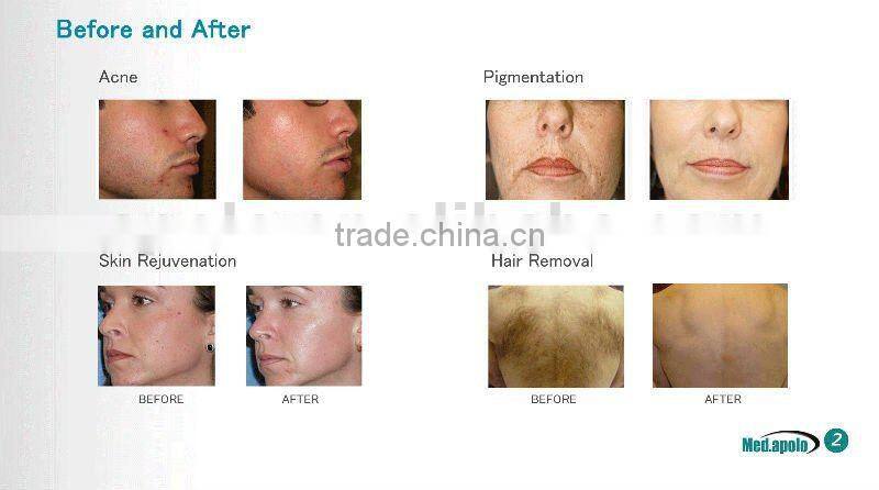 New product Elight innovative products for import HS 316 by shanghai med apolo medical technology
