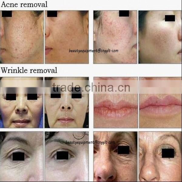 Scar/Wart/Acne Removal Fractional CO2 Laser