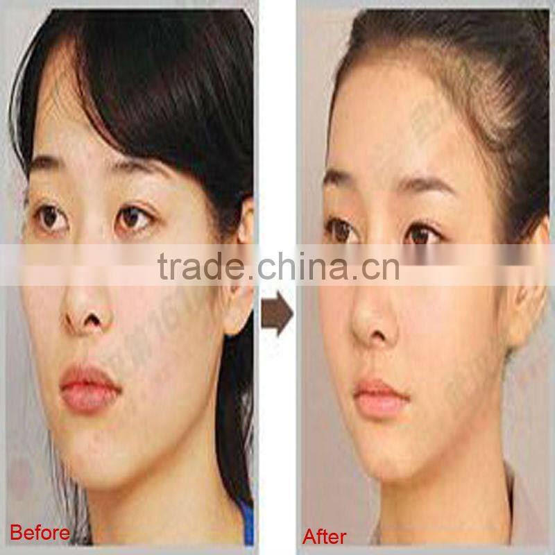 VY-N30 High Speed Mesotherapy Injection Gun For Skin Rejuvenation