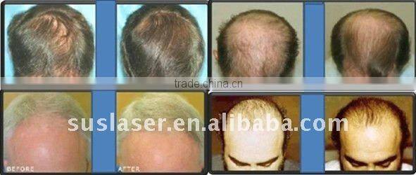 Hair growth laser! wholesale skin treatment anti wrinkle BL005, CE/ISO