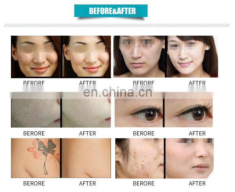 Factory price 4 in 1 korea shr+ipl+rf hair removal tattoo removal nd yag laser 532nm 1064nm 1032nm skin lift beauty machine