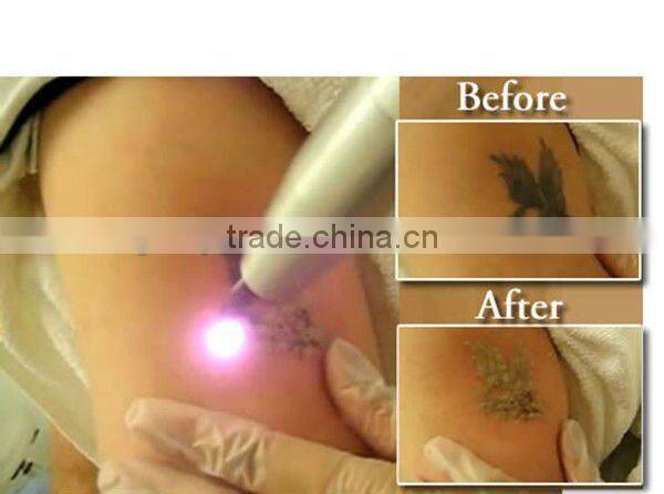 Nd:Yag laser tattoo removal machine