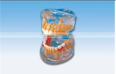 pathology Transparent teeth model