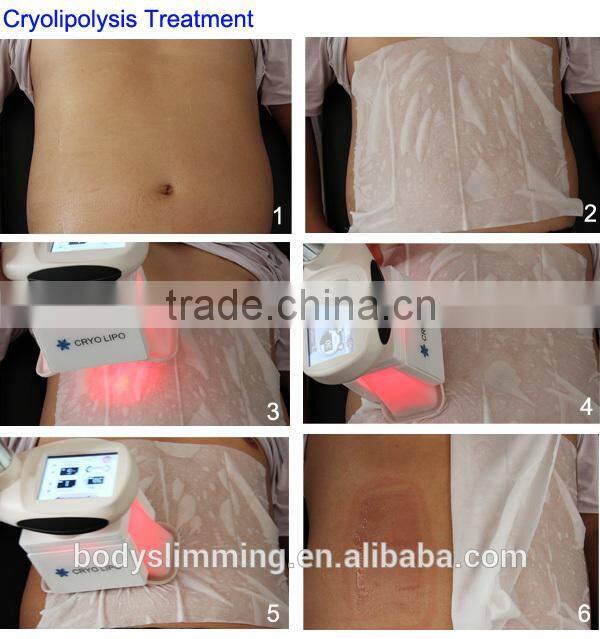Portable cryolipolysis freeze machine fat layer reduction machine