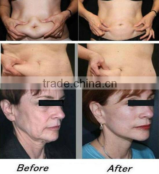 Beauty RF criolipolisis equipment Cyclone Shape