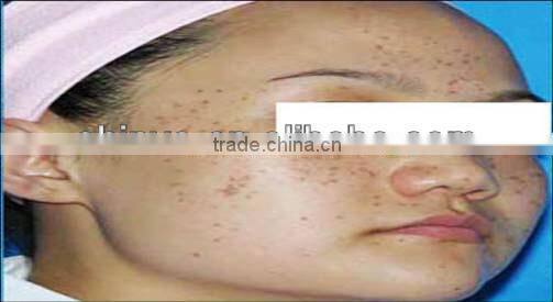 1064nm&532nm Q-switch Nd:YAG laser machine