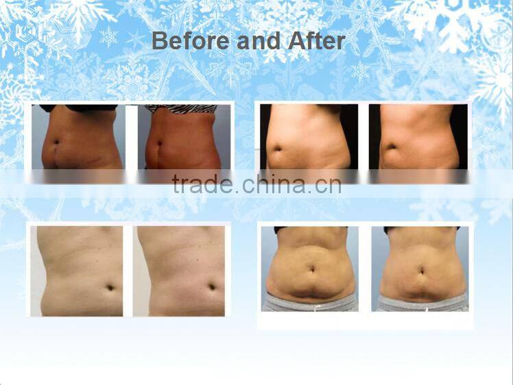 hifu body slimming machine