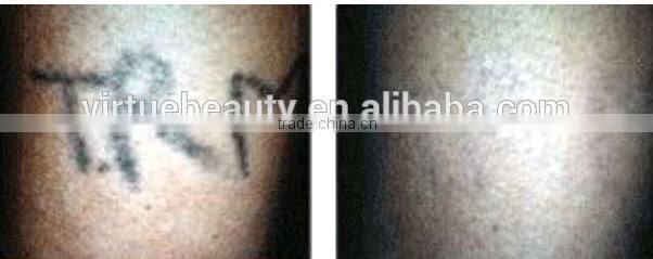 Long pulsed ND YAG laser for tattoo removal