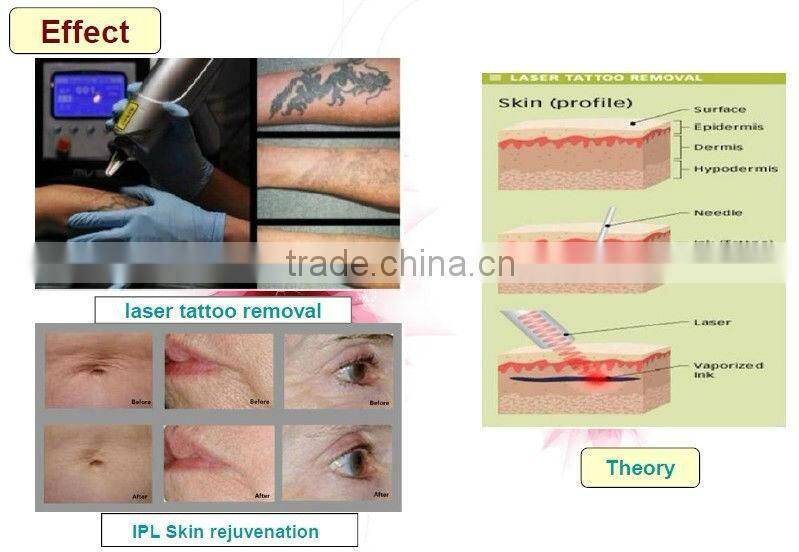 professional hair and tattoo removal machine with Q-Switch ND YAG