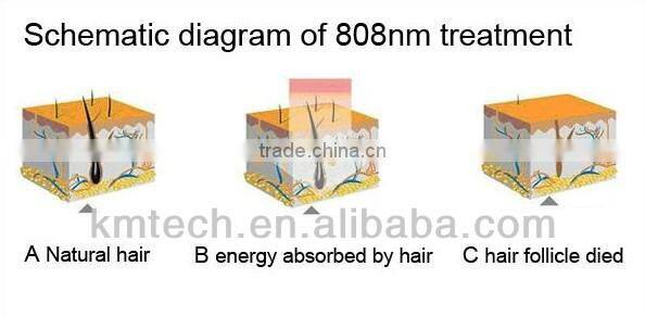 professional dilas 808nm diode laser hair removal machine