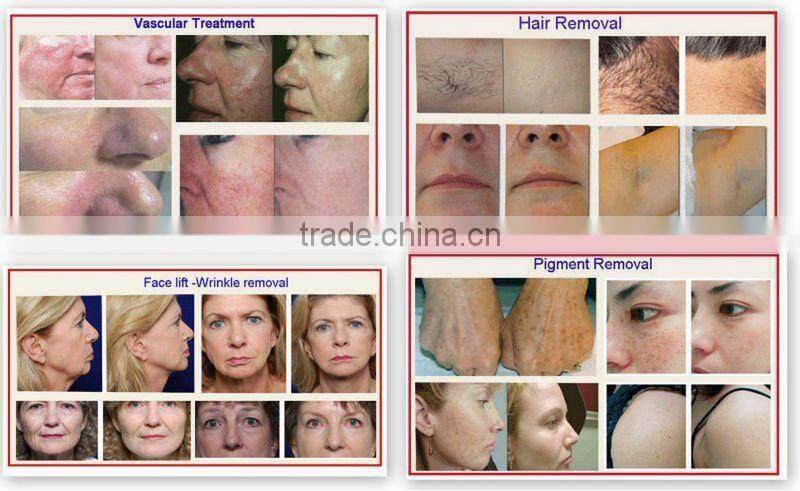 Portable home use ipl shr hair removal machine for beauty spa salon