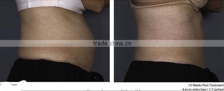 New fat killer HIFU slimming machine