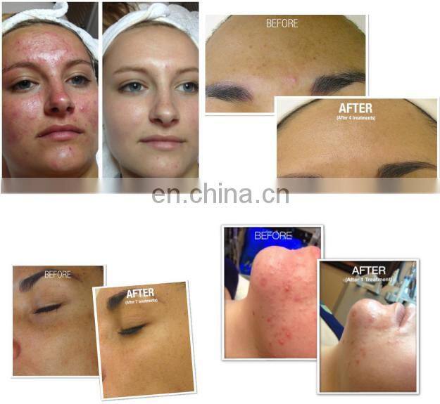 Professional 8 in 1 ultrasonic face deep cleaning dermabrasion machine with pdt