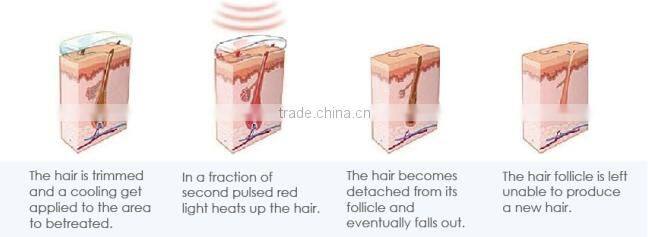 2015 Top quality best seller diode laser / 808nm diode laser hair removal