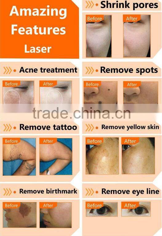 nd yag laser q switch/nd yag laser beauty machine/nd yag laser