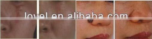 Professional Skin Resurfacing medical fractional co2 laser beauty machine