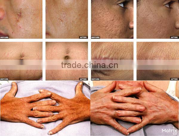 Fractional Co2 Laser for skin rejuvenation beauty equipment