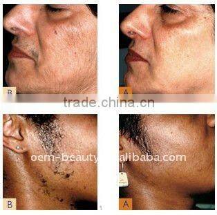 beauty studio nail fungus treatment laser hair removal device-P003