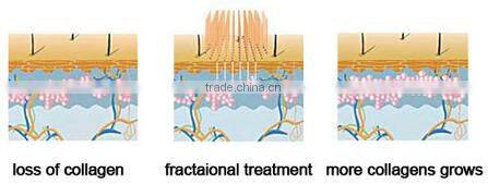 CE Approval CO2 Fractional Laser Med-870 RF Tube Fractional CO2 Laser 2015