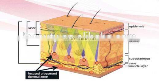 2015 Focused ultrasound fat reduce Hifu slimming system