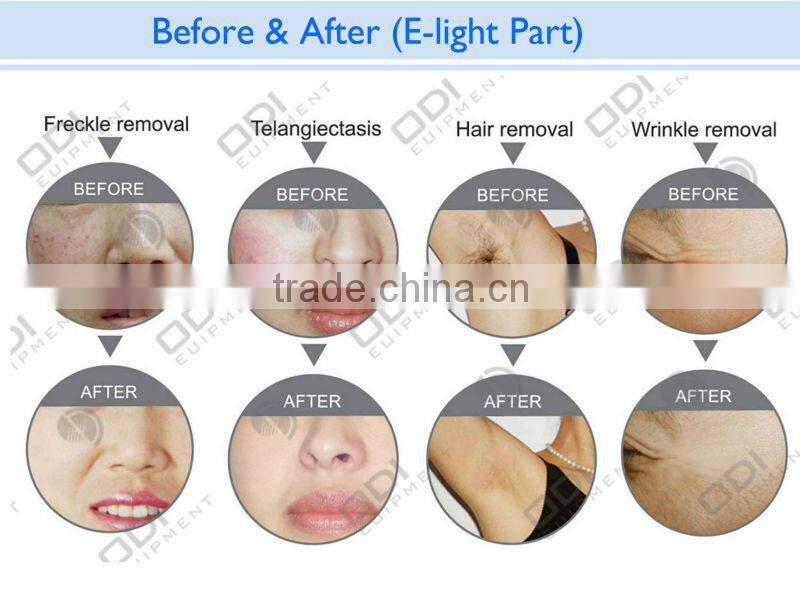 instant effect Laser+RF+IPL multifunction beauty machine with CE approved IRL20