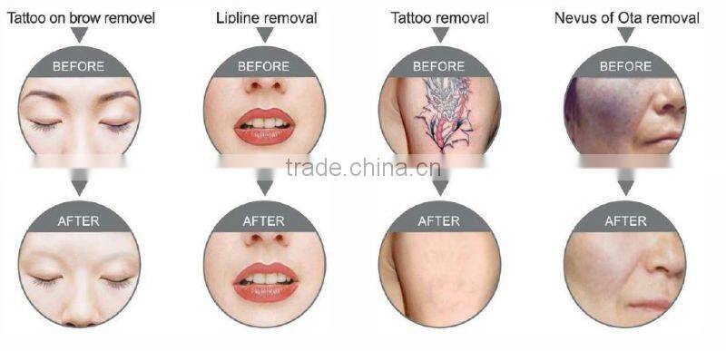 nd yag laser tattoo removal machine with 3 wavelength