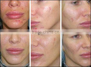 2013Newest IPL technology hair removal never shave or wax again