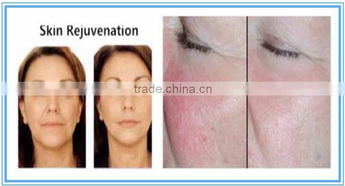 ipl laser hair removel epilation machine lumenis price for sale with ce