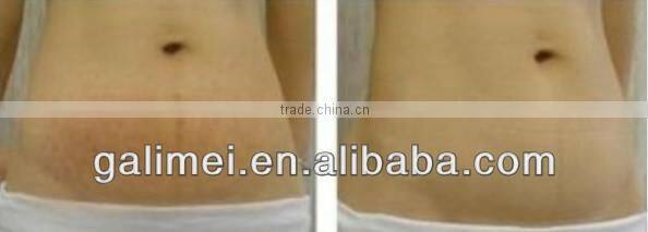 Home use Auto Micro Needle Device with CE