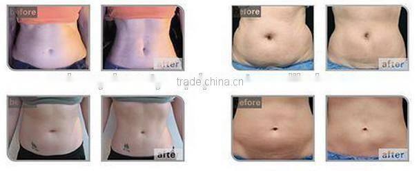 fat reduce hifu ultrason cavitation body slimming machine cellulite machine