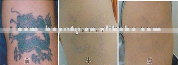 Nd. Yag laserlaser tattoo removal machine D001 China mianland manufacture