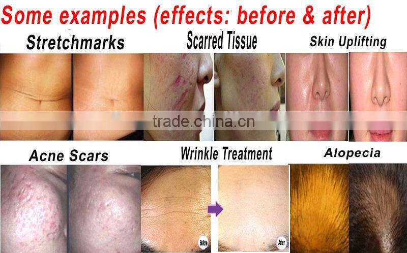 540 needles derma roller micro needle skin nurse system stainless steel microneedle roller acne scar anti-aging wrinkle treatmen