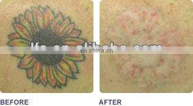 Switch ND YAG Laser price/tatto removal machine/ q swithed laser