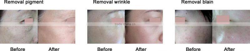 Fractional CO2 Laser beauty for superfacial Acne scar surgery equipment with medical CE and ISO approved