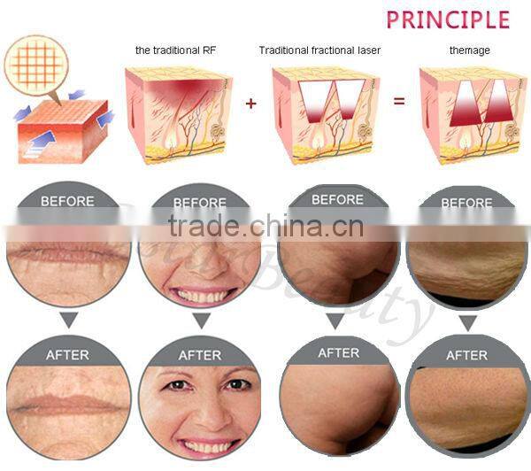 Fractional rf microneedle